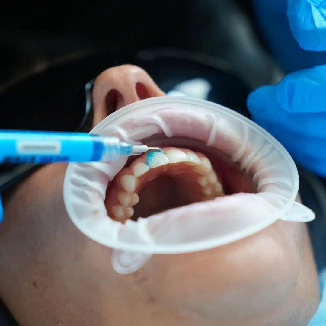 Natural-looking cosmetic dentistry smile result with subtle whitening, bonding and aligned teeth at Regent Dental