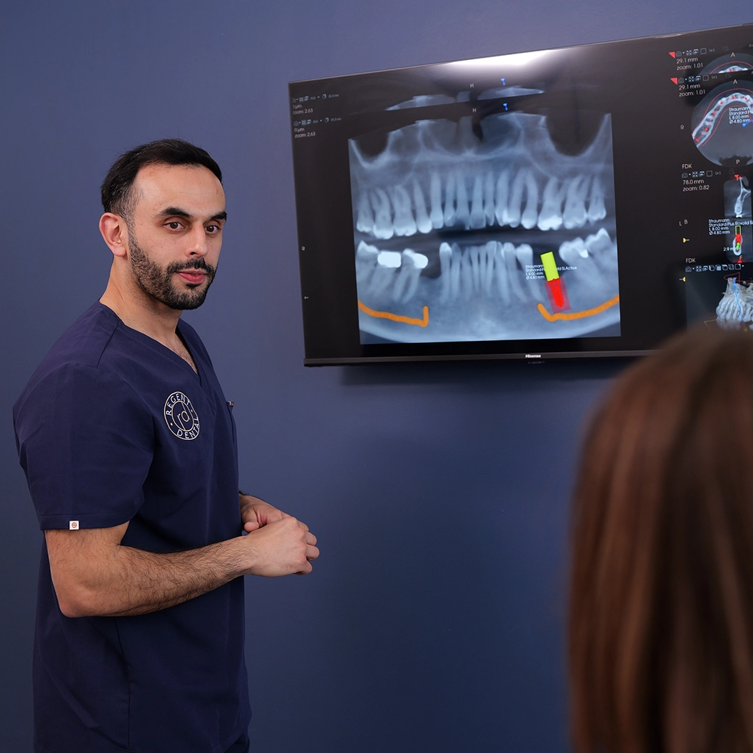 Full Arch Dental Implants