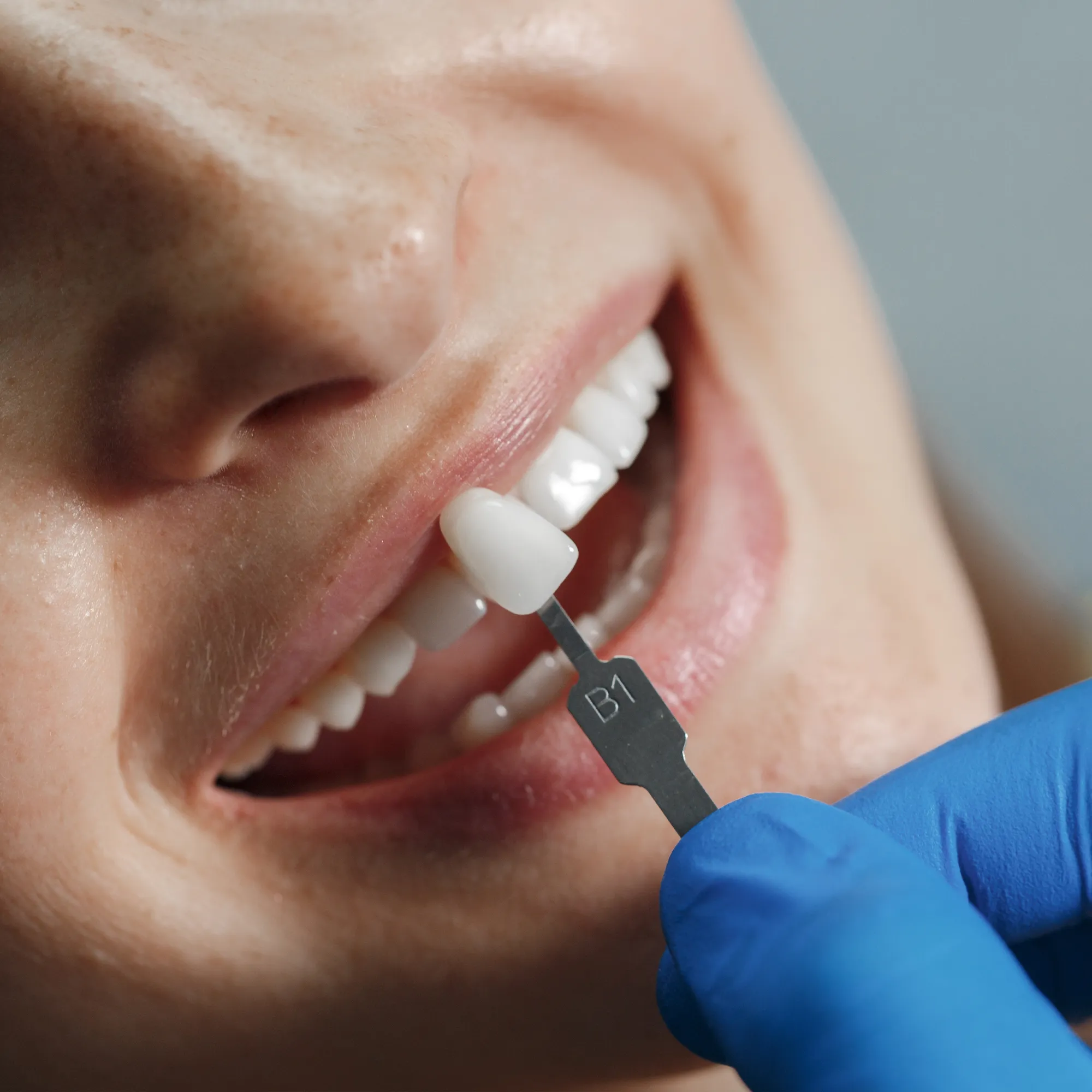 Composite Bonding Can Instantly Transform Your Smile