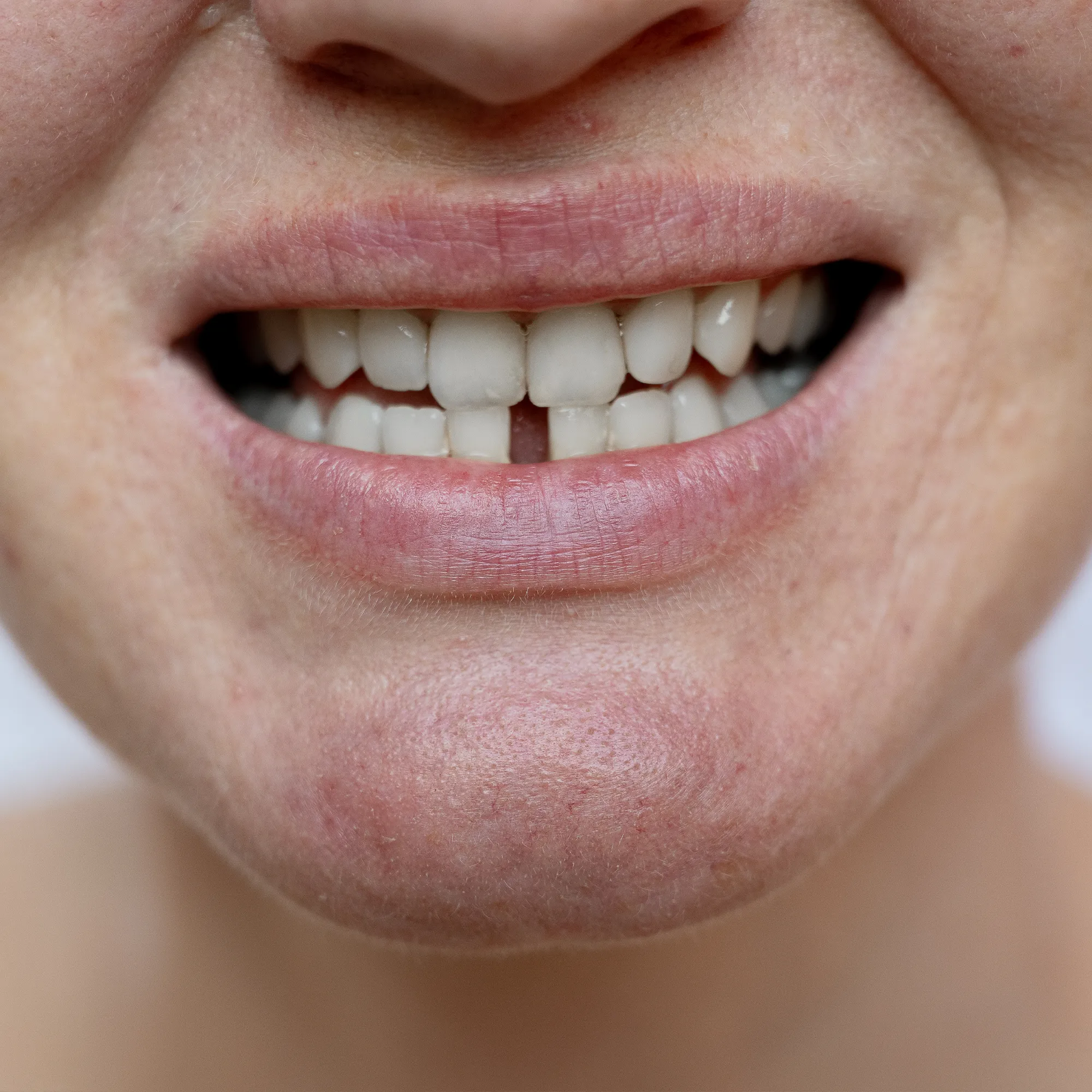 Long-Term Benefits Of Replacing Missing Teeth