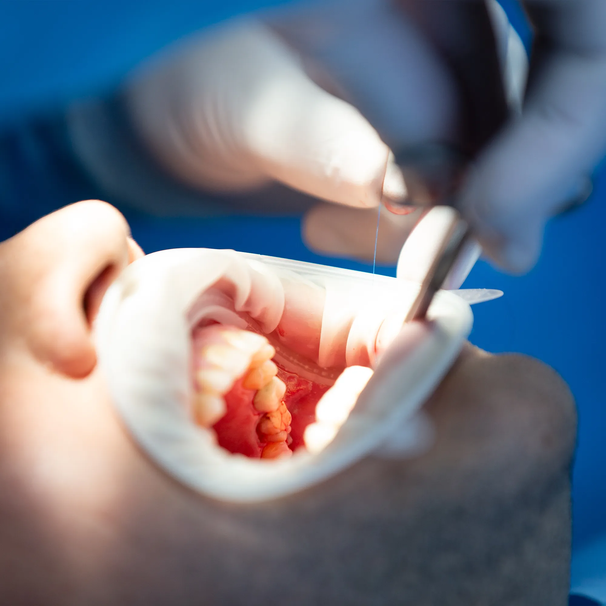 After Your Dental Implant Surgery